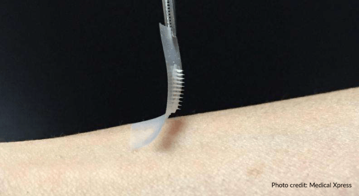 Groundbreaking BioScience-microneedle